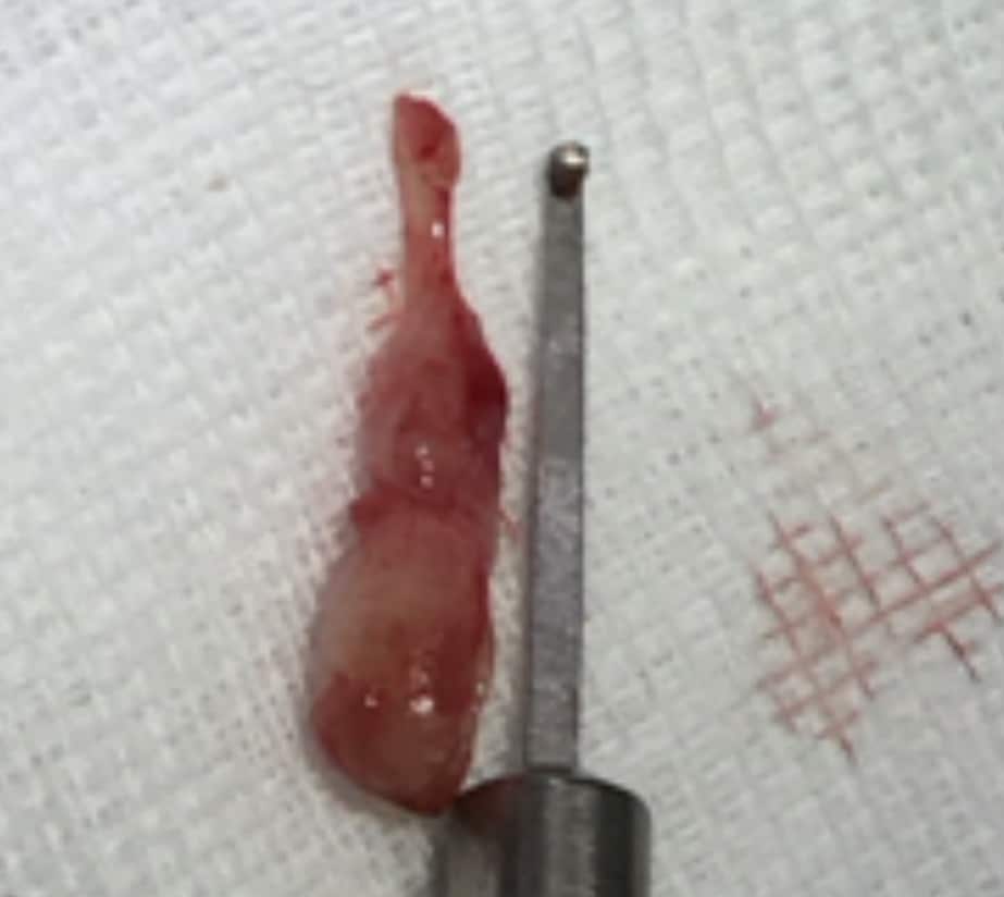 Entfernter Ohrpolyp von 2,5 cm Länge bei der jungen Maine-Coon-Katze